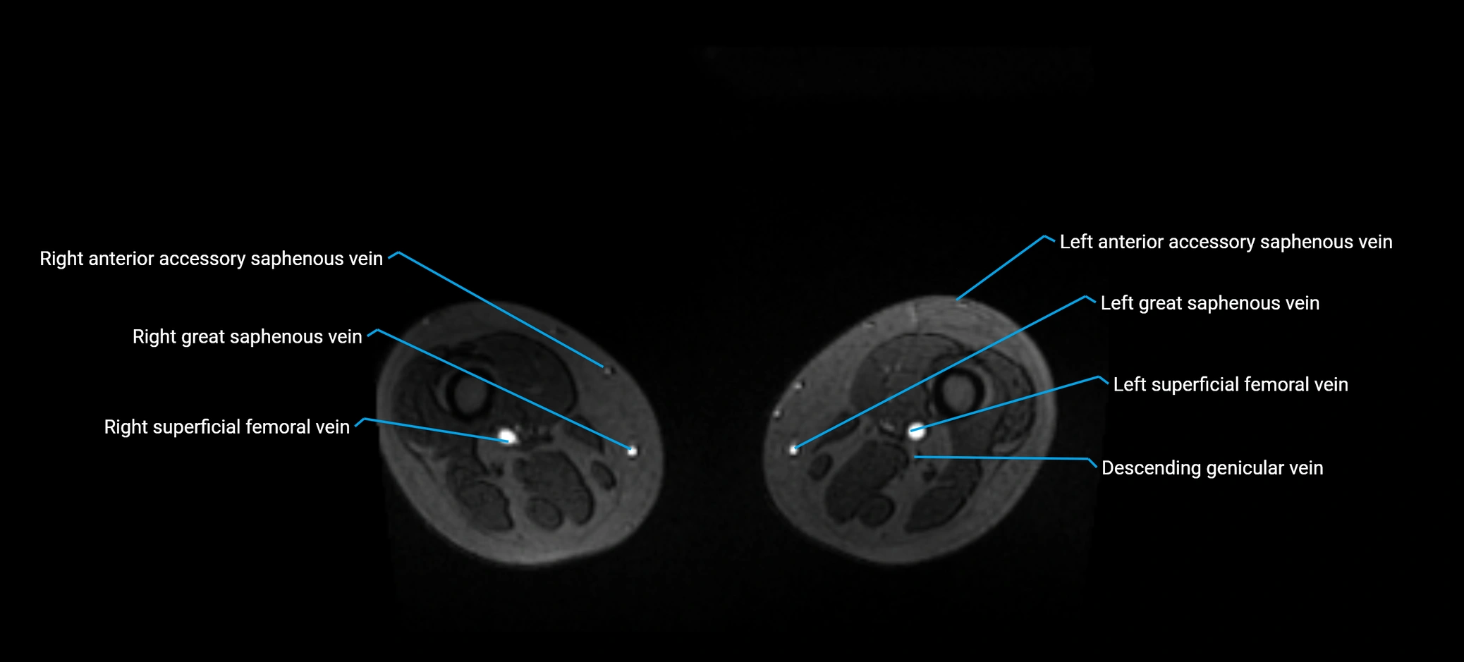 MRV abdomen pelvis & lower limb axial cross sectional anatomy labelled MRI image 315.webp